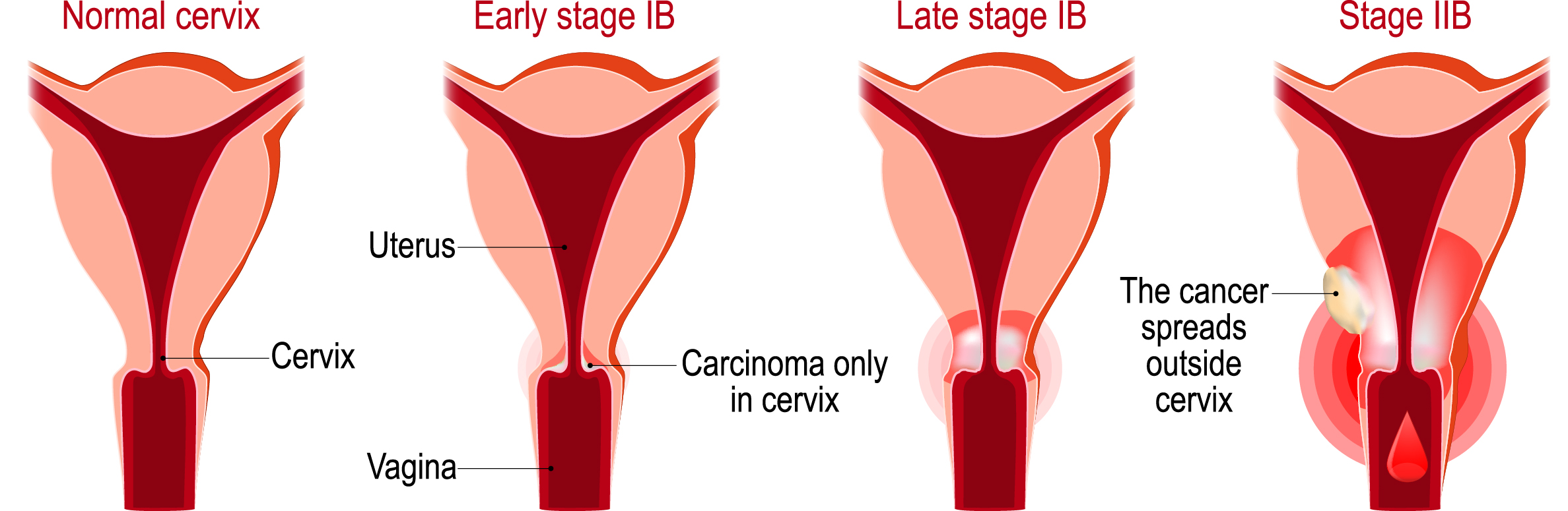 cervical cancer diagram